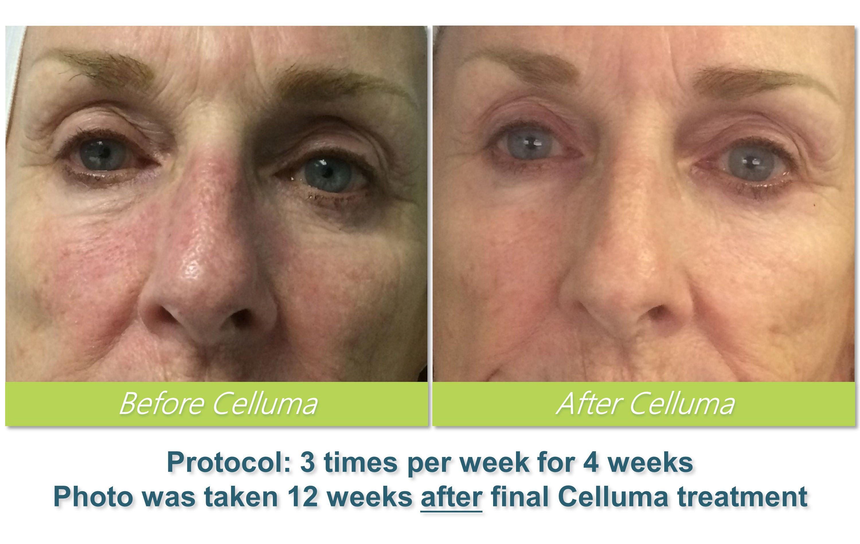 Celluma (LED) Light Therapy