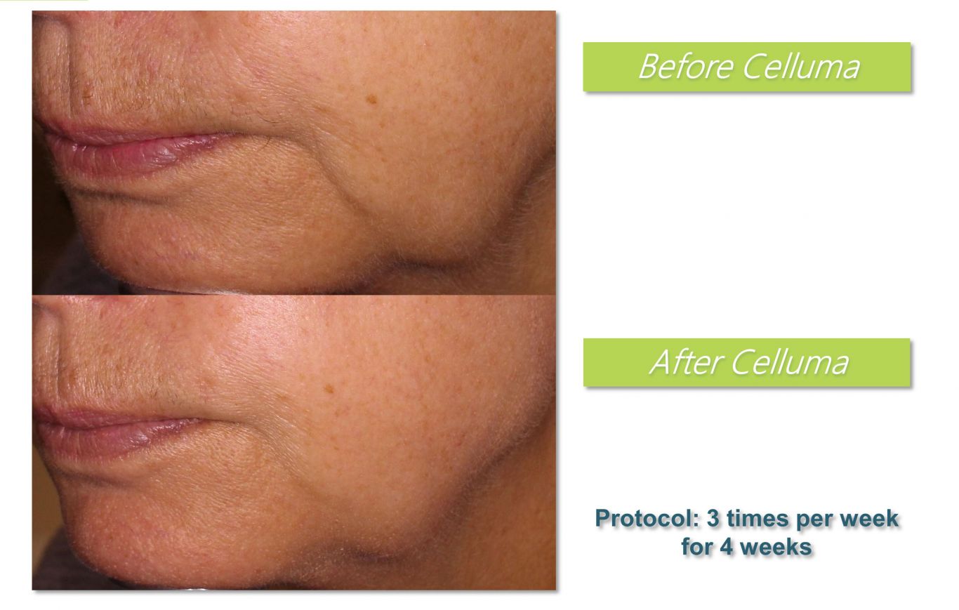 Celluma (LED) Light Therapy