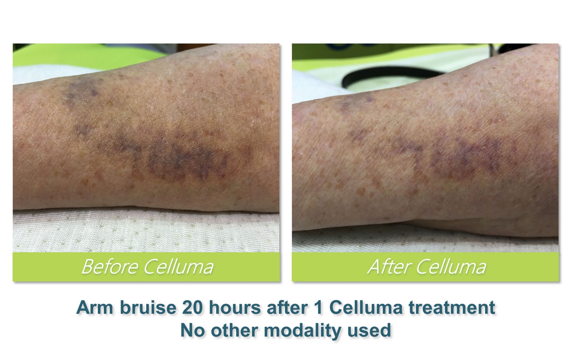 Celluma (LED) Light Therapy