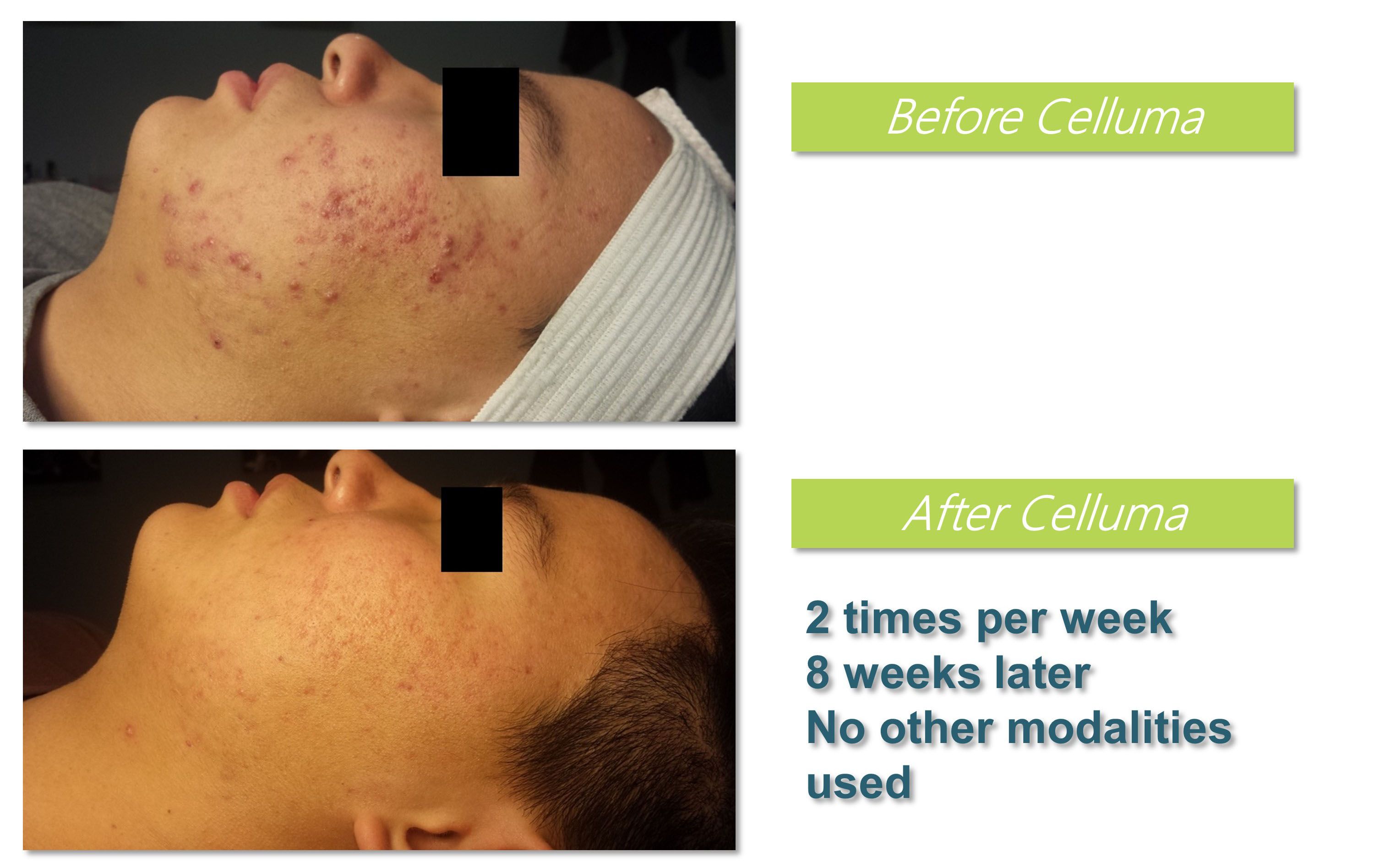 Celluma (LED) Light Therapy